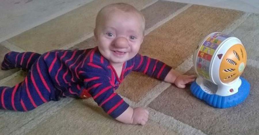 Storia incredibile,bimbo nasce con il cervello nel naso